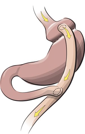 gastric-bypass-300w