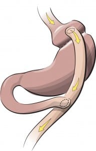 gastric-bypass-857w