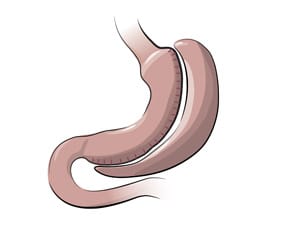 gastric-sleeve-bypass-300w